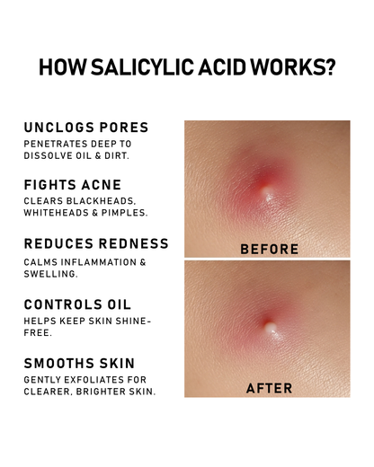 Camou 50mL Salicylic Acne Body Spray